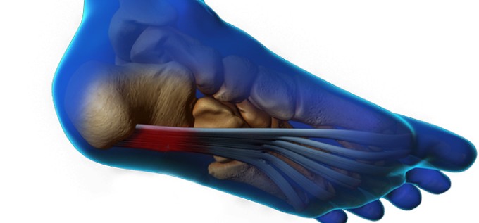 fascitis_plantar_slider_1